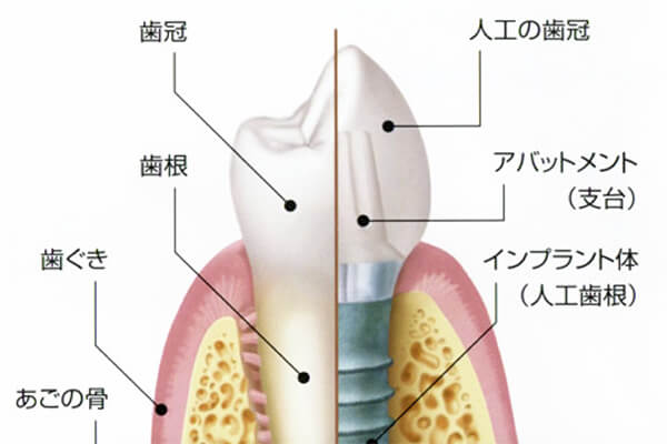 インプラント治療