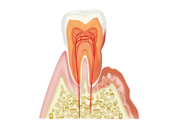 歯周病治療